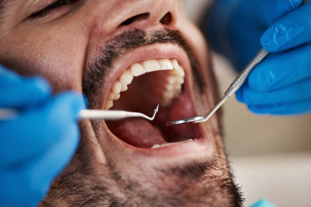 Best Chipped Tooth Repair Near Me  in Churchill, MT